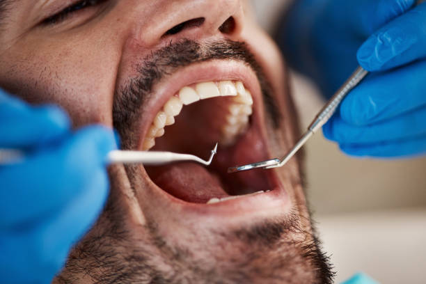 Best Emergency Tooth Extraction in Soh Weber, UT